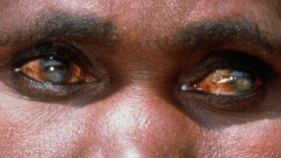 _85917944_m2300177-woman_with_river_blindness-spl